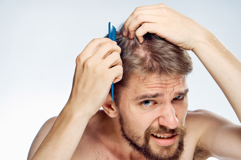 Testosterone and hair Loss Treatment Man Upset of Baldness