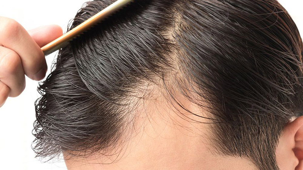 Will Hair Grow Back After Testosterone Treatment Man Combing His Hair